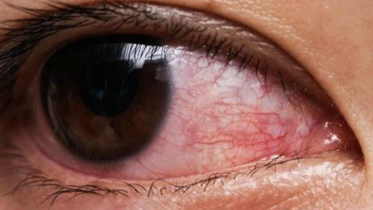 vedere oculară boală oculară